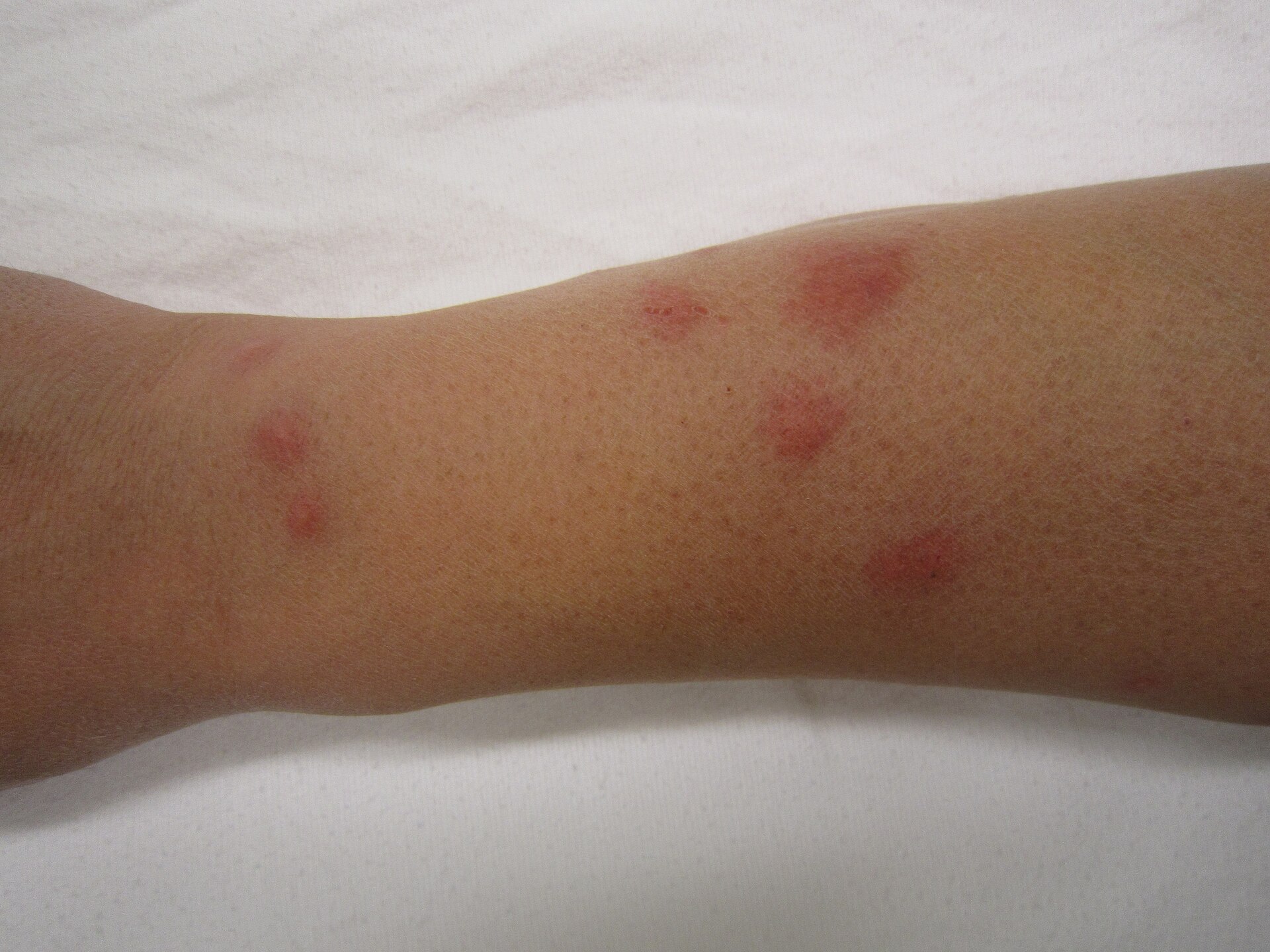 Cluster of red raised bed bug bite welts on a person’s forearm resting on a white sheet