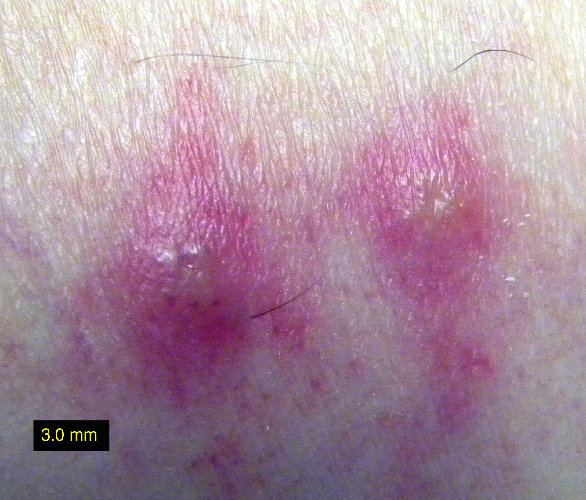 Cluster of red raised chigger bites on skin around the ankle