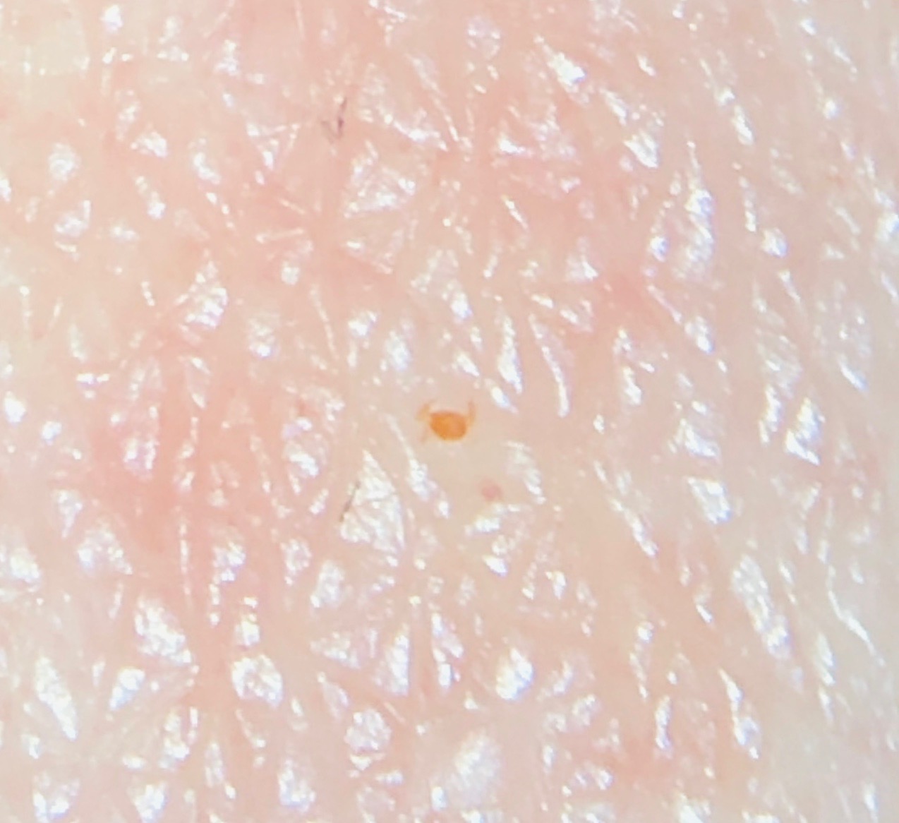 Highly magnified red chigger larva attached to human skin