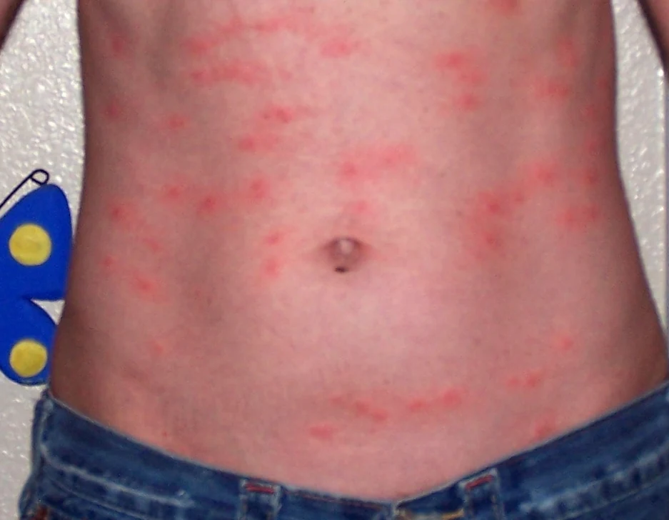 Many red chigger bites across the stomach, concentrated just above the waistband of jeans