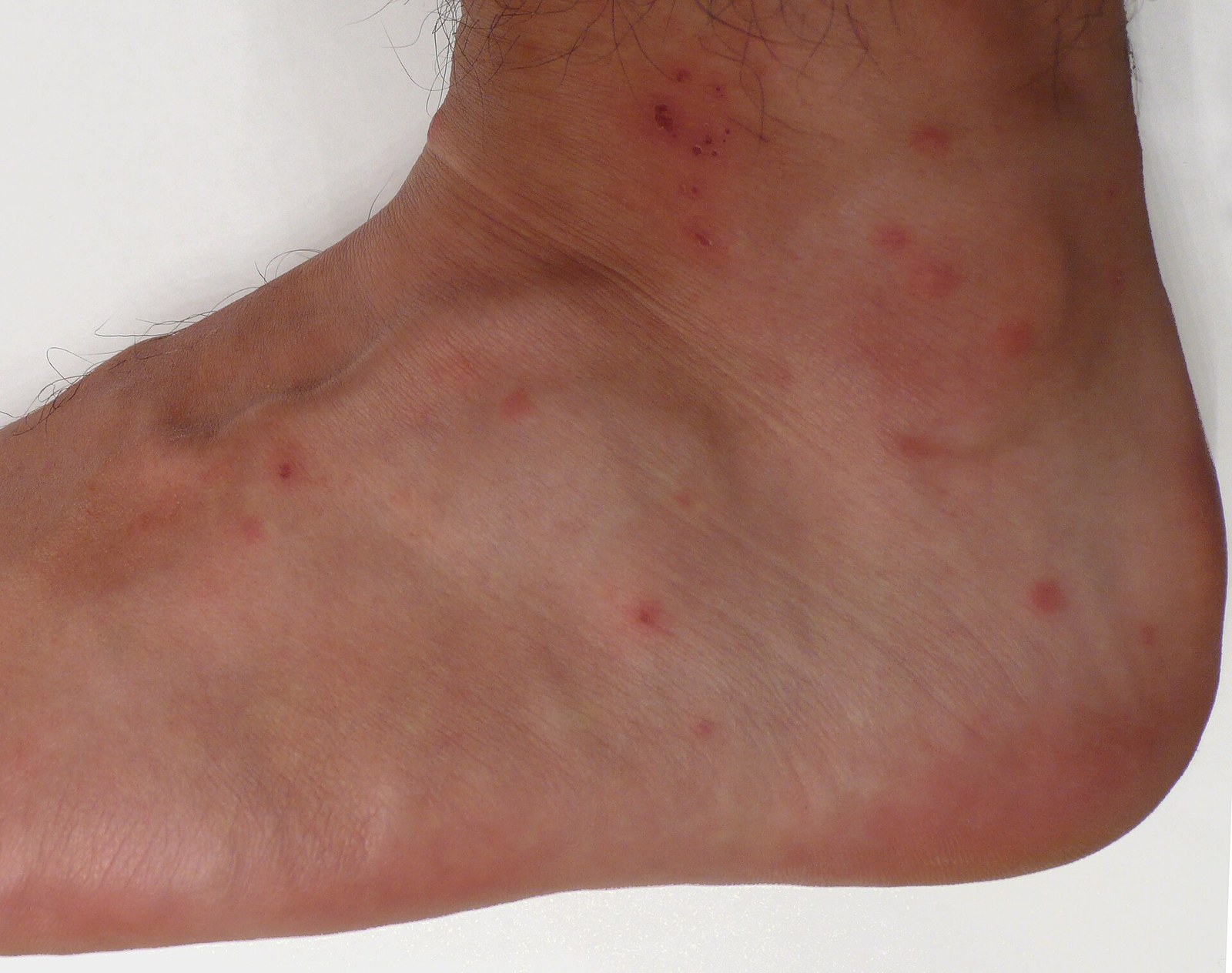 Small red chigger bites scattered across the top and side of a foot and ankle