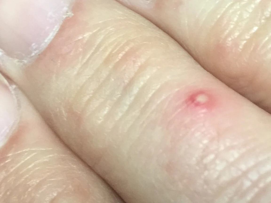 Small raised white pustule with a red ring on the side of a finger, one day after a fire ant sting